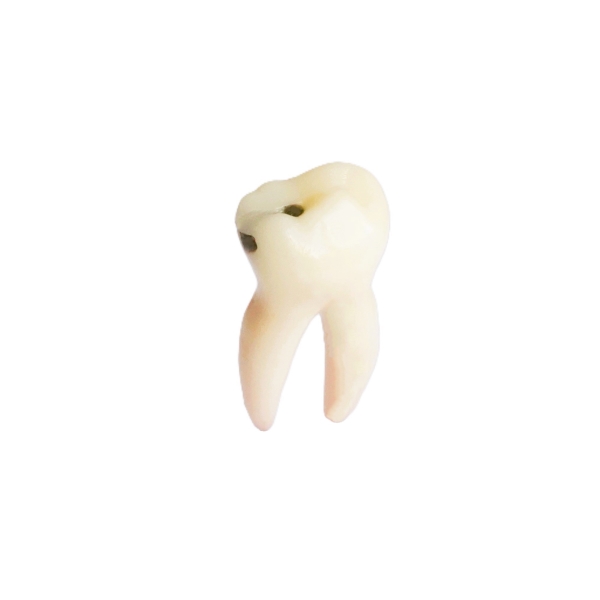 PedoPrep® 74 Numara Distal-Oklüzal Çürüklü Diş