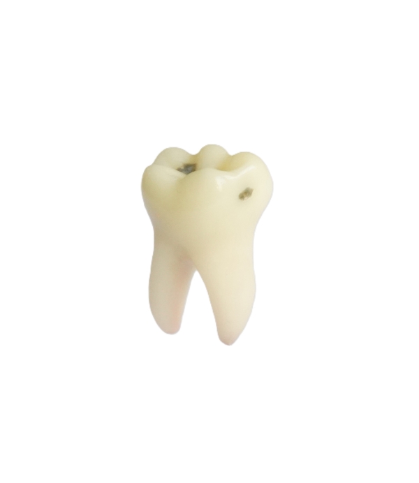 PedoPrep® 75 Numara Distal-Oklüzal Çürüklü Diş